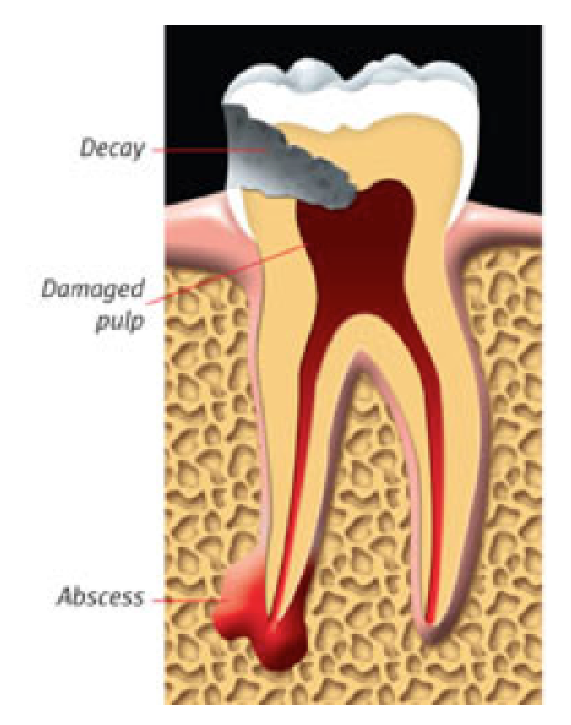 An abscessed tooth.
