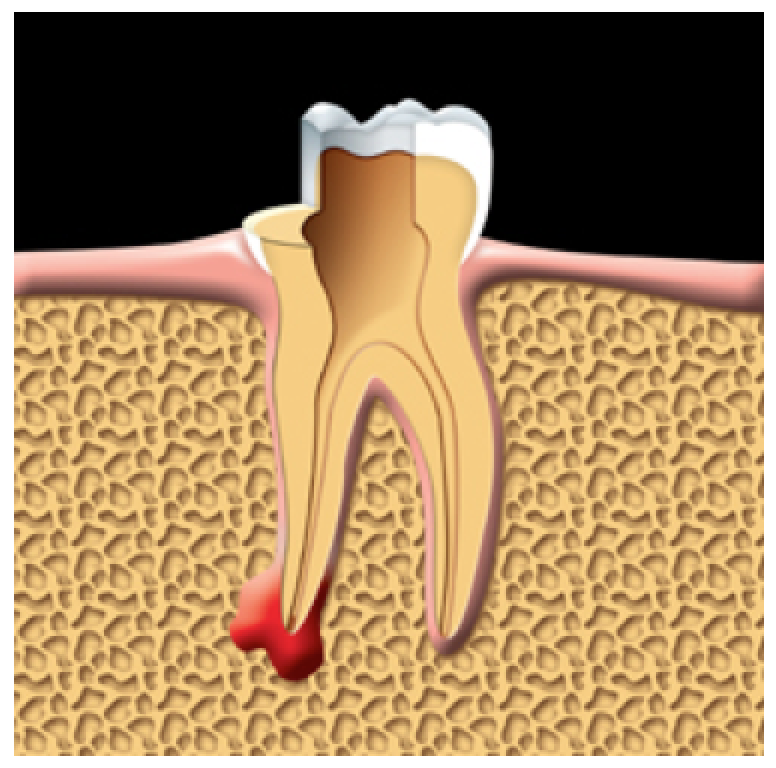 The damaged pulp is removed. 