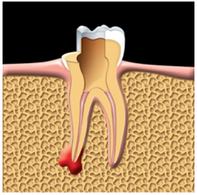 The root canals are filled and sealed.