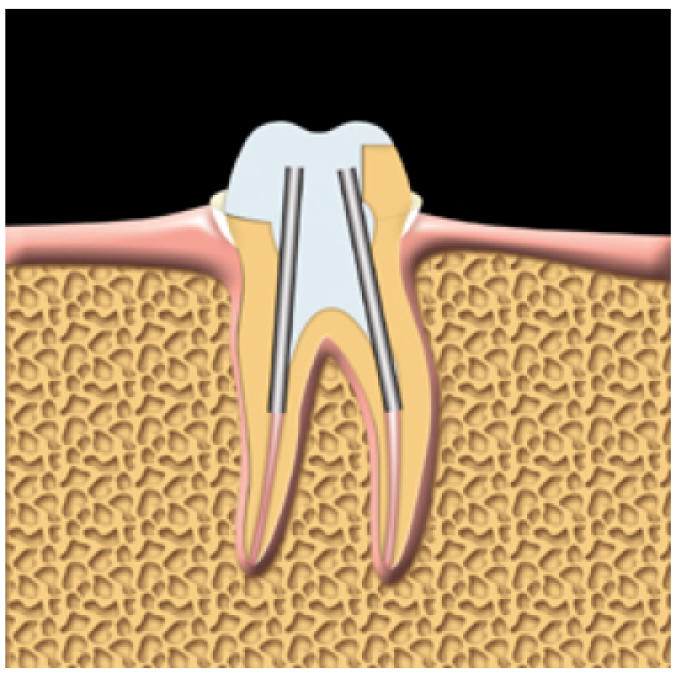 The tooth is prepared for a crown. Posts are used to help support the crown.